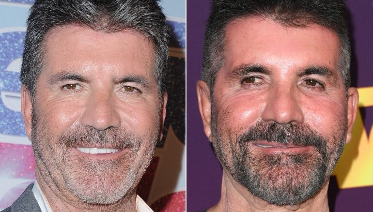 WHAT HAPPENED TO SIMON COWELL’S FACE? EXPERT EXPLAINS