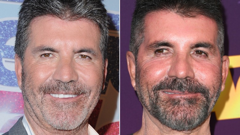 WHAT HAPPENED TO SIMON COWELL’S FACE? EXPERT EXPLAINS