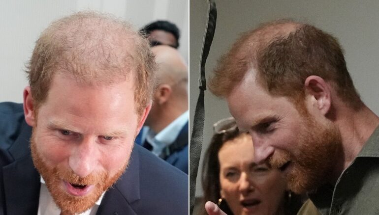 Prince Harry’s bald patch exposed in Australia.